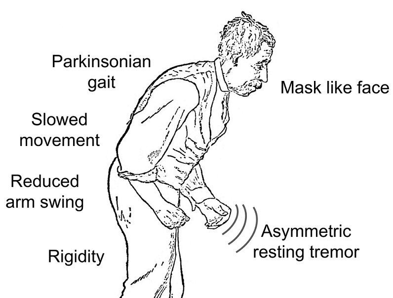 Bệnh Parkinson là bệnh mạn tính tiến triển nặng dần theo thời gian